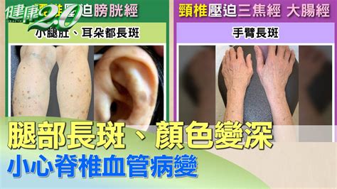 腳背長斑|腿長不明斑點！醫揭恐「3原因」造成...惱人色素這樣。